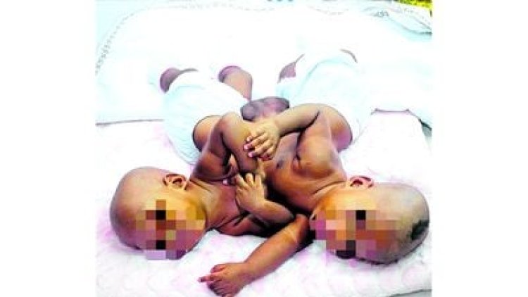 Tanzania: Ibitaro byatandukanyije abana bimpanga bavutse bafatanye.