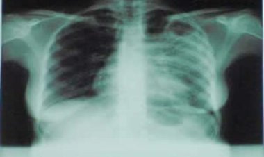 Mu Rwanda 60% by'abarwaye igituntu ntibajya kwa muganga kukivuza